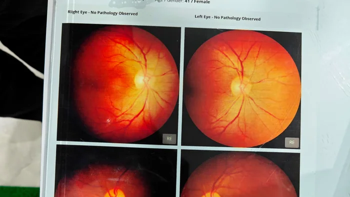 Retina Imaging & Diabetic Eye Screening Karaikal – Actual Fundus Screening Report at Dr. Reddy's