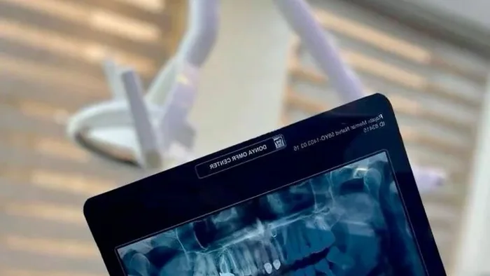 Root Canal Treatment Karaikal – OPG X-Ray Guided Endodontics at Dr. Reddy's Dental
